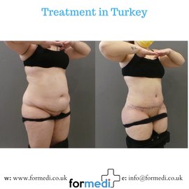 Tummy Tuck formedi Turkey