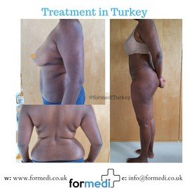 Tummy Tuck formedi Turkey