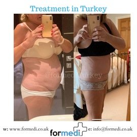 Tummy Tuck formedi Turkey