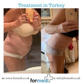 Tummy Tuck formedi Turkey