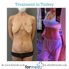 Tummy Tuck formedi Turkey