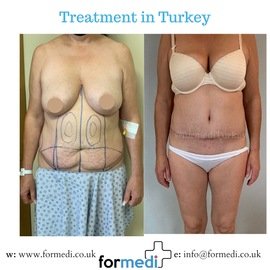 Tummy Tuck formedi Turkey