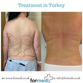 Tummy Tuck formedi Turkey