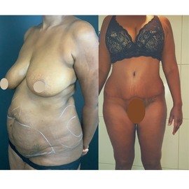 Tummy Tuck formedi Turkey