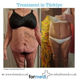 Tummy Tuck formedi Turkey
