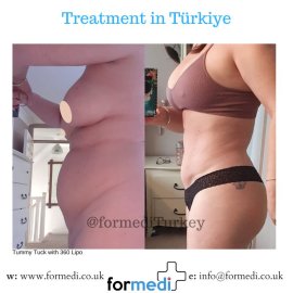 Tummy Tuck formedi Turkey