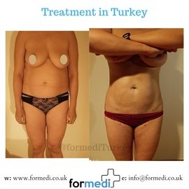 Vaser Liposuction in Antalya