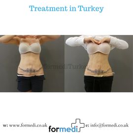 Liposuction at formedi Antalya