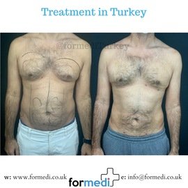 Liposuction at formedi clinic