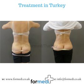 Liposuction at formedi Antalya2