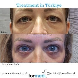 Blepharoplasty