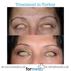Blepharoplasty