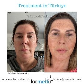 Face Lift Surgery formedi Turkey