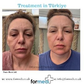 Face Lift Surgery formedi Turkey