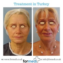 Face Lift Surgery formedi Turkey