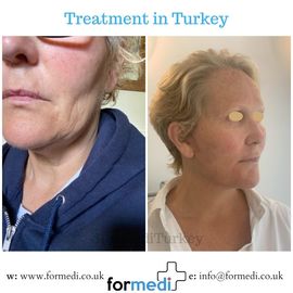 Face Lift Surgery formedi Turkey