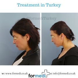 Face Lift Surgery formedi Turkey