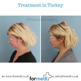 Face Lift Surgery formedi Turkey
