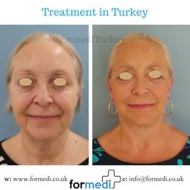 Face Lift Surgery formedi Turkey