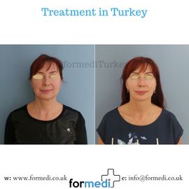 Face Lift Surgery formedi Turkey