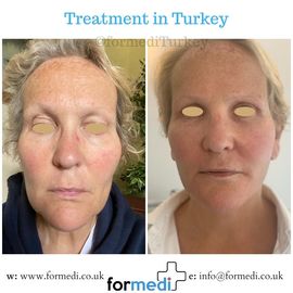 Face Lift Surgery formedi Turkey