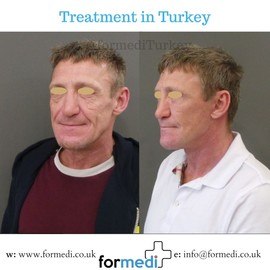Face Lift Surgery formedi Turkey