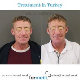 Face Lift Surgery formedi Turkey