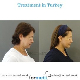 Face Lift Surgery formedi Turkey
