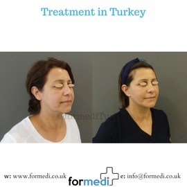 Face Lift Surgery formedi Turkey