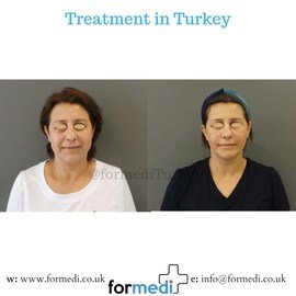 Face Lift Surgery formedi Turkey