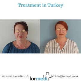 Face Lift Surgery formedi Turkey