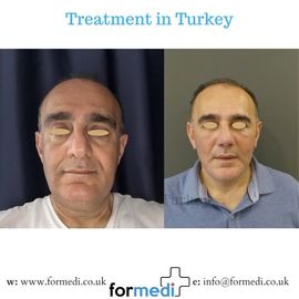 Face Lift Surgery formedi Turkey