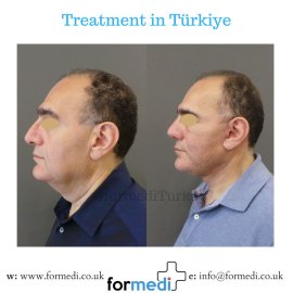 Face Lift Surgery formedi Turkey