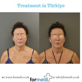 Face Lift Surgery formedi Turkey