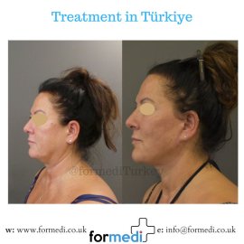 Face Lift Surgery formedi Turkey