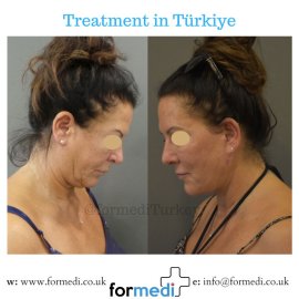 Face Lift Surgery formedi Turkey