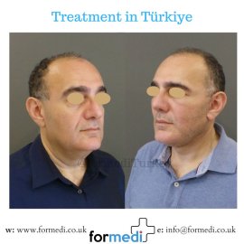 Face Lift Surgery formedi Turkey