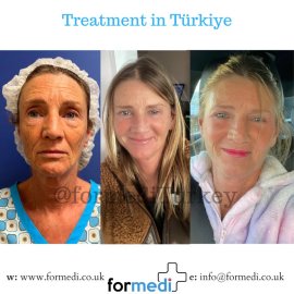 Face Lift Surgery formedi Turkey