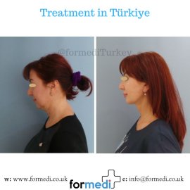 Face Lift Surgery formedi Turkey