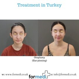 Otoplasty Surgery at formedi Turkey