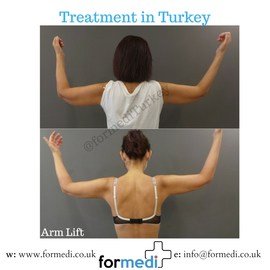Arm Lift Surgery at formedi clinic2