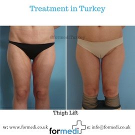 Thigh Lift Surgery at formedi clinic
