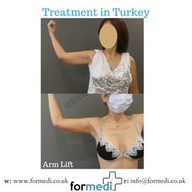 Arm Lift Surgery at formedi clinic
