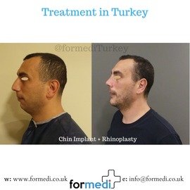 chin implant surgery turkey