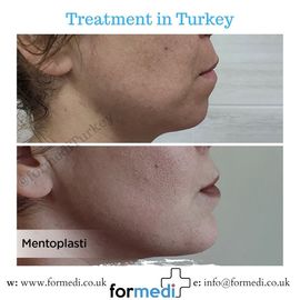 Chin Implant in Turkey