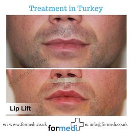 Lip Lift in Turkey