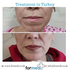 Chin Implant in Turkey