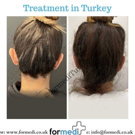 Otoplasty Surgery at formedi Turkey