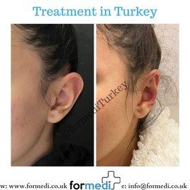 Otoplasty Surgery at formedi Turkey