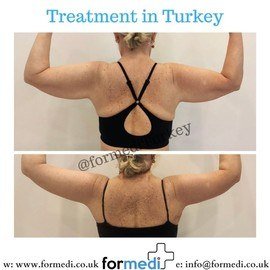 Arm Lift Surgery at formedi